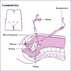 Laparoscopia in gravidanza – Chirurgia Laparoscopica